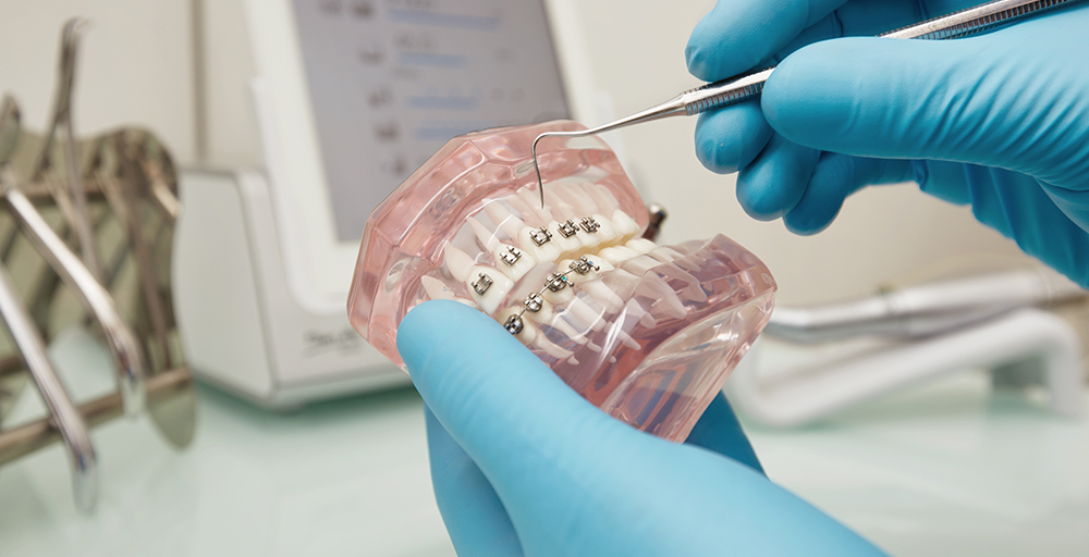 Braces Namma Dentist