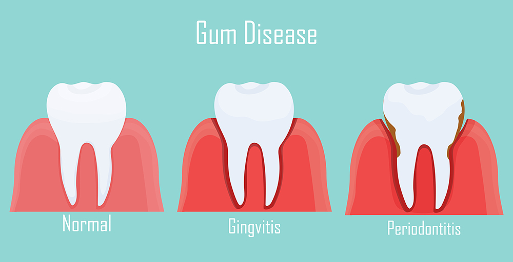 Gum Treatment